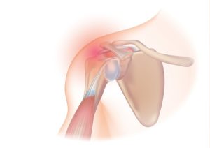 rotator cuff injury