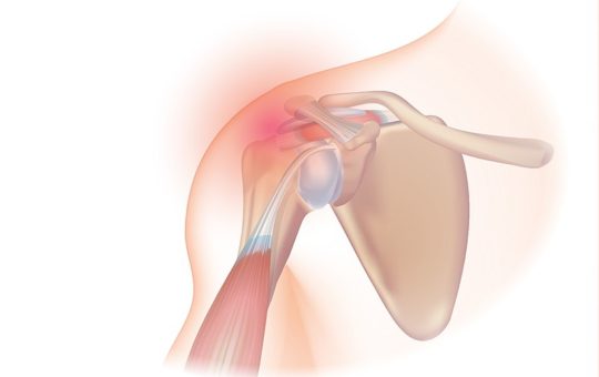rotator cuff injury